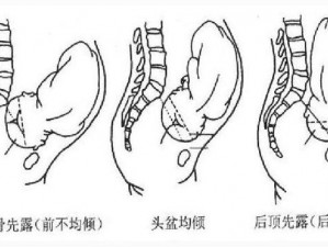 帝王肚腹挺起难产塞胎头-难产帝王肚腹挺起，胎头如何娩出？