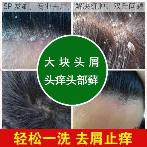 SP 发刷，专业去屑，解决红肿、双丘问题