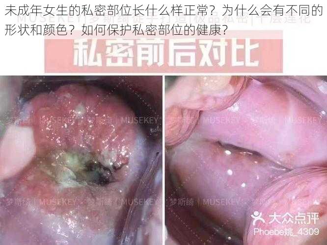 未成年女生的私密部位长什么样正常？为什么会有不同的形状和颜色？如何保护私密部位的健康？